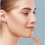 Rhinoplasty